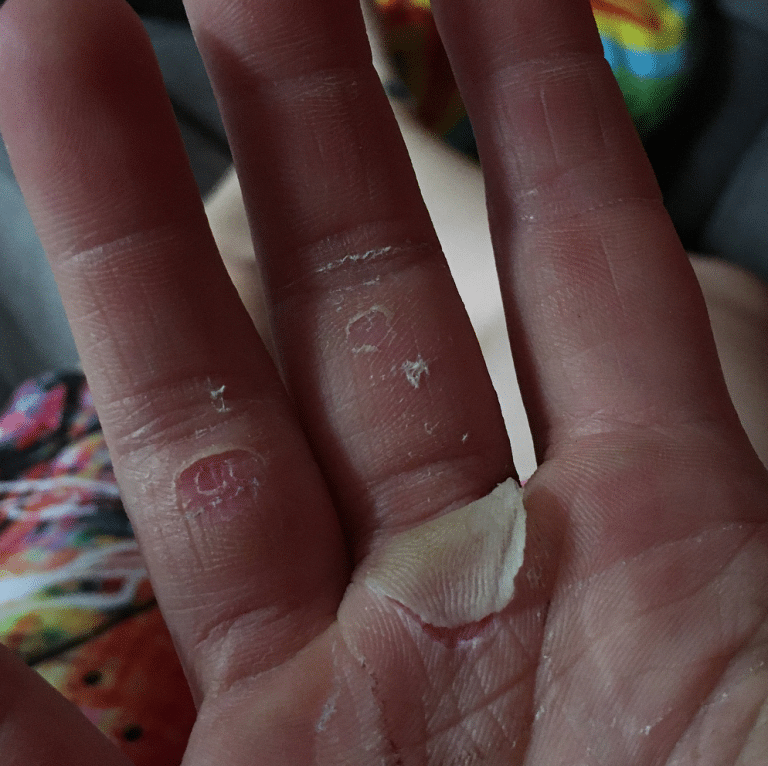 Climbing and bouldering hand care how to tape flappers to the palm?